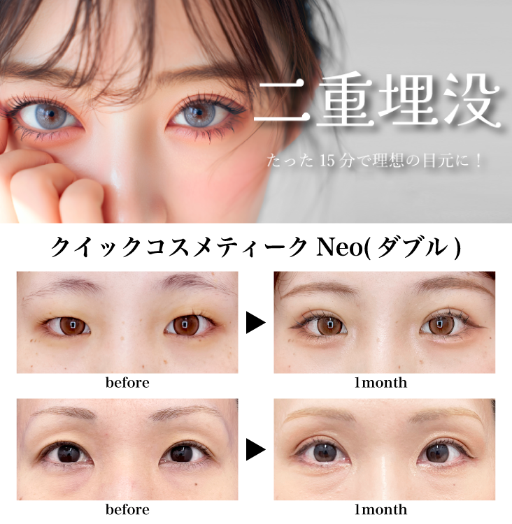 二重埋没