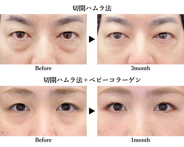 表ハムラ(切開ハムラ)法