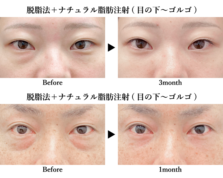 目の下の切らないクマ取り・たるみ（ふくらみ）取り【脱脂法】