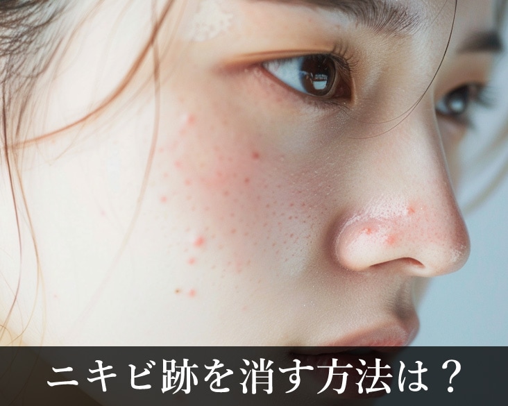 横浜エリアでニキビ跡を治療するなら？原因・セルフケア・おすすめ施術を解説【SBC新横浜院】