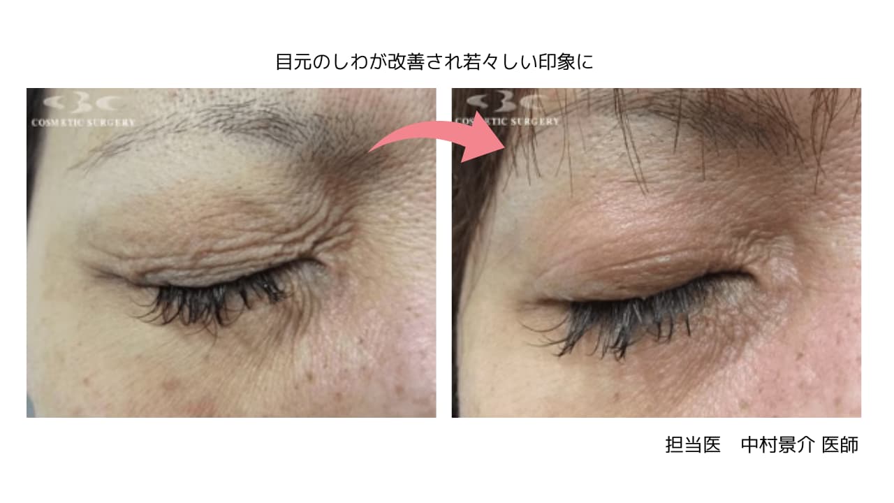目元のしわが気になる方