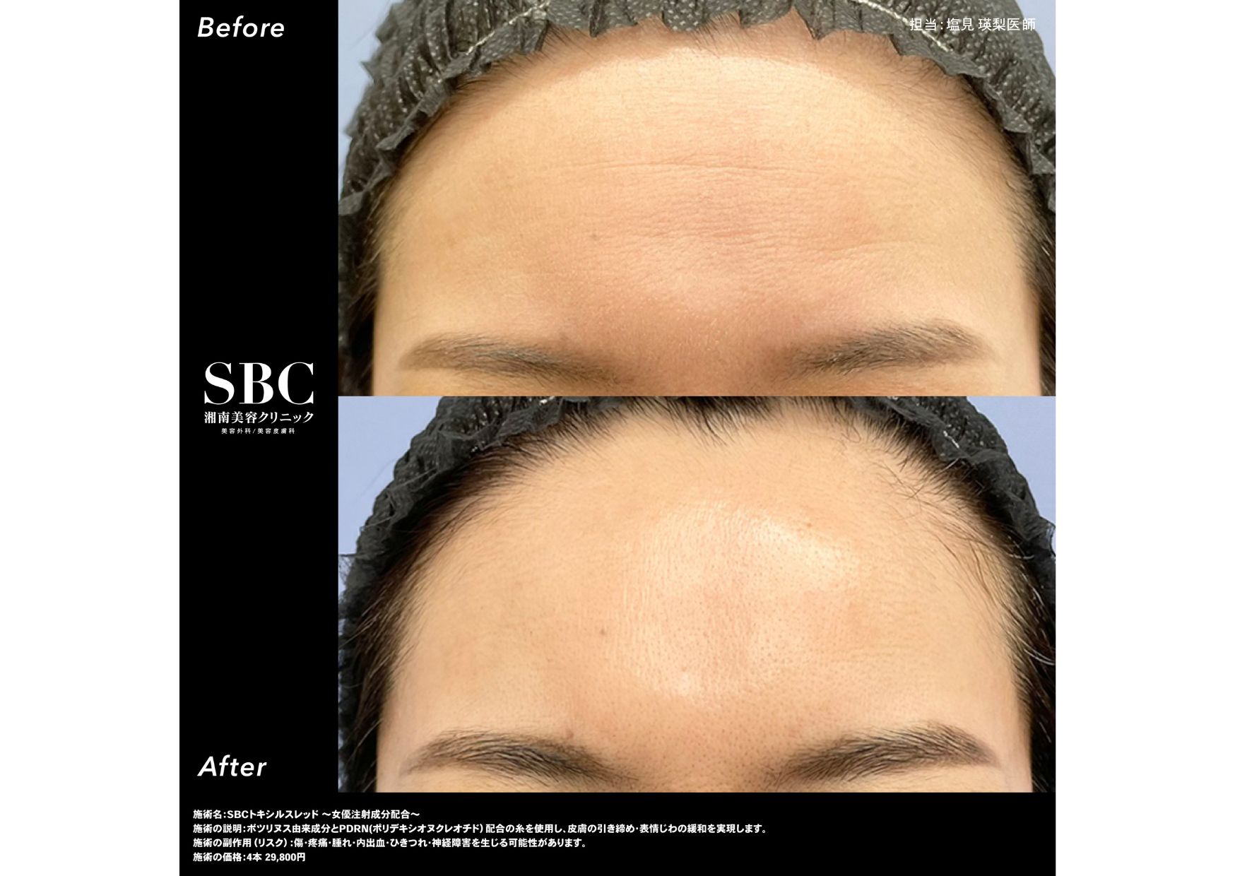 <b>SBCトキシルスレッド</b>〜女優注射(R)成分配合〜