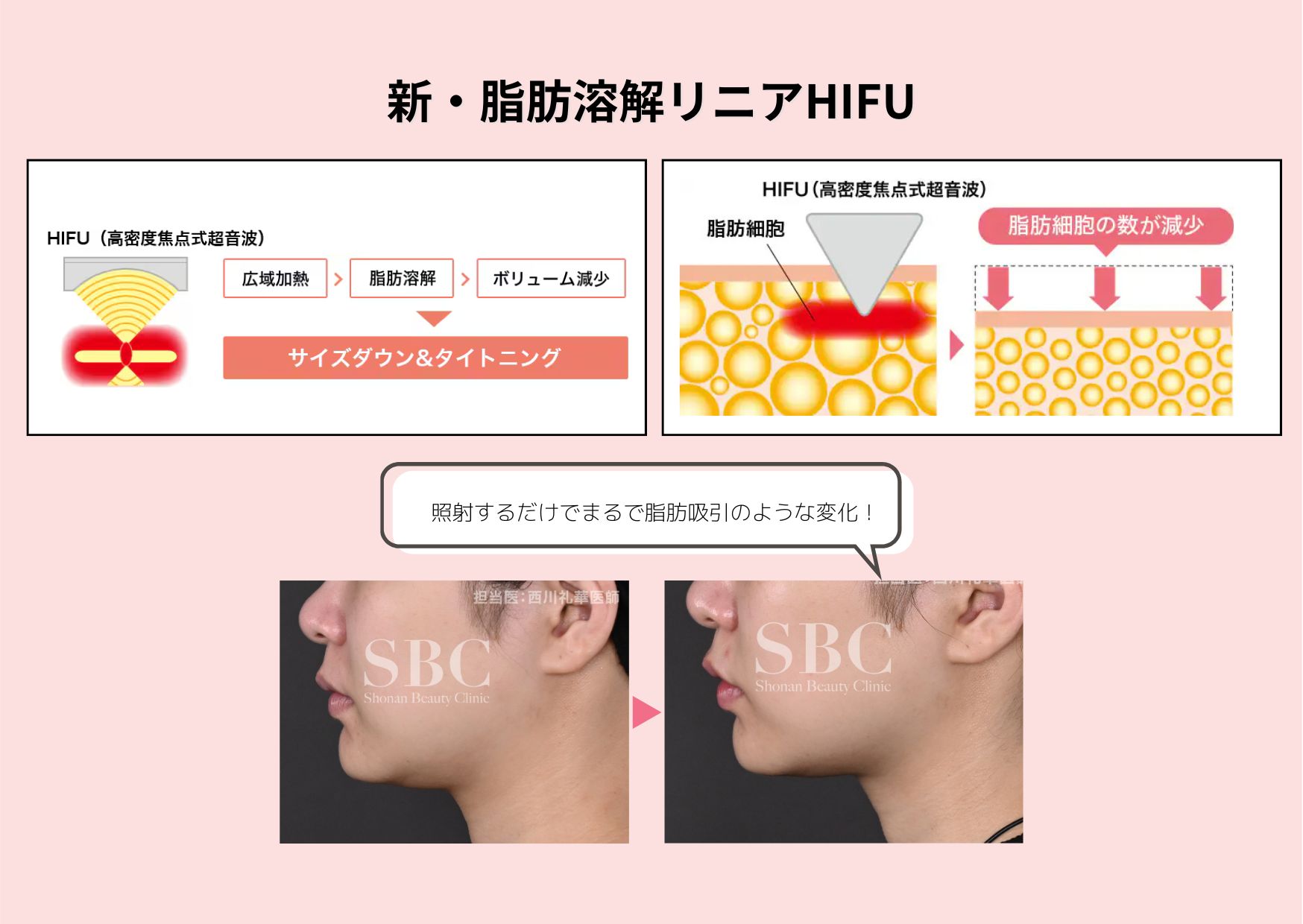  切らずに小顔！！！