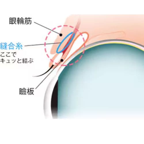 従来の埋没二重とはなにが違う？