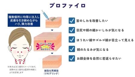 プロファイロ（ヒアルロン酸）