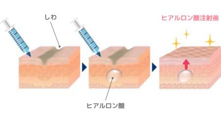 ヒアルロン酸とは？もともと肌にある成分に近い製剤を使用