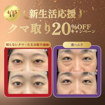 新生活応援！クマ取り 20％OFFキャンペーン