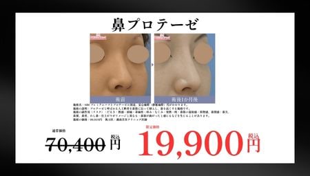 鼻プロテーゼ