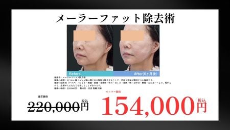 メーラーファット除去