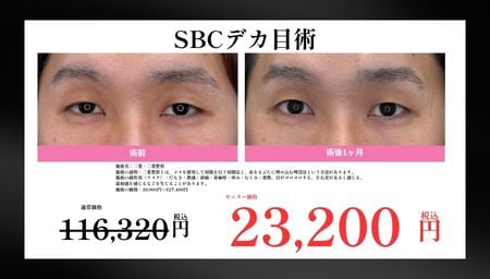 SBCデカ目術