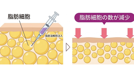 脂肪細胞を破壊して体外に排出する、シンプルだけど強力な仕組み