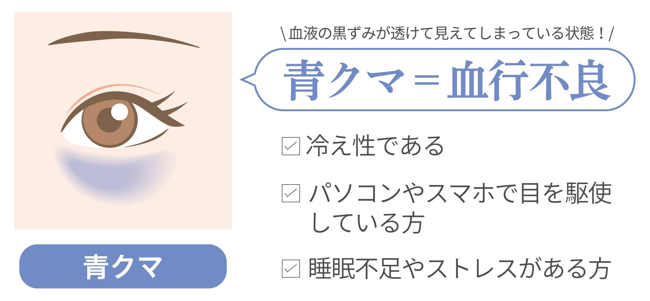 血行不良により、血液の黒ずみが透けて見えてしまっている状態の「青クマ」