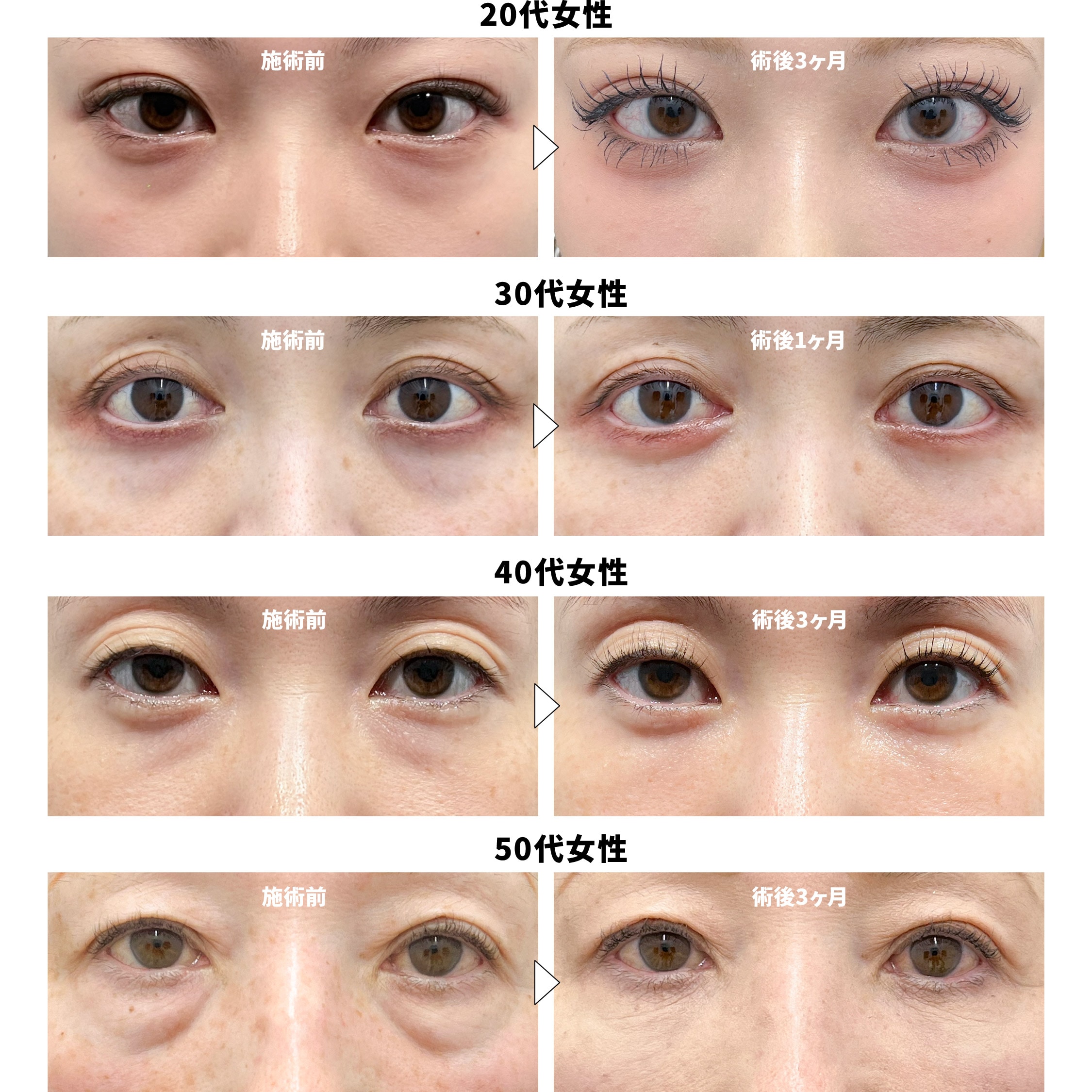 【年齢別】女性のクマ取り治療症例