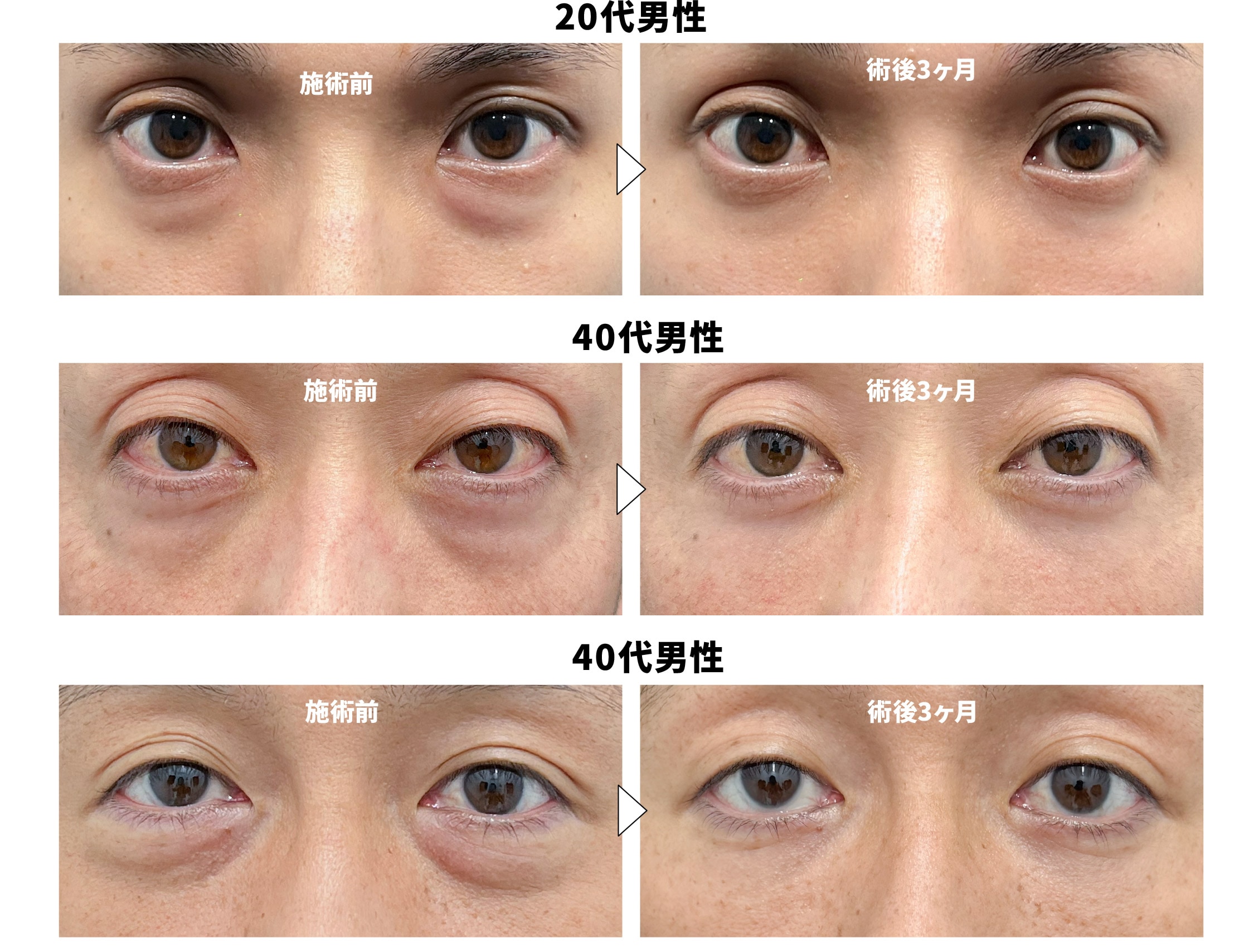 【年齢別】男性のクマ取り治療症例