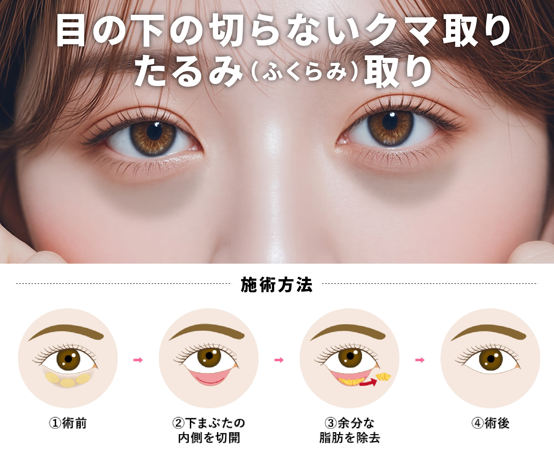 目の下の切らないクマ取り・たるみ（ふくらみ）取り