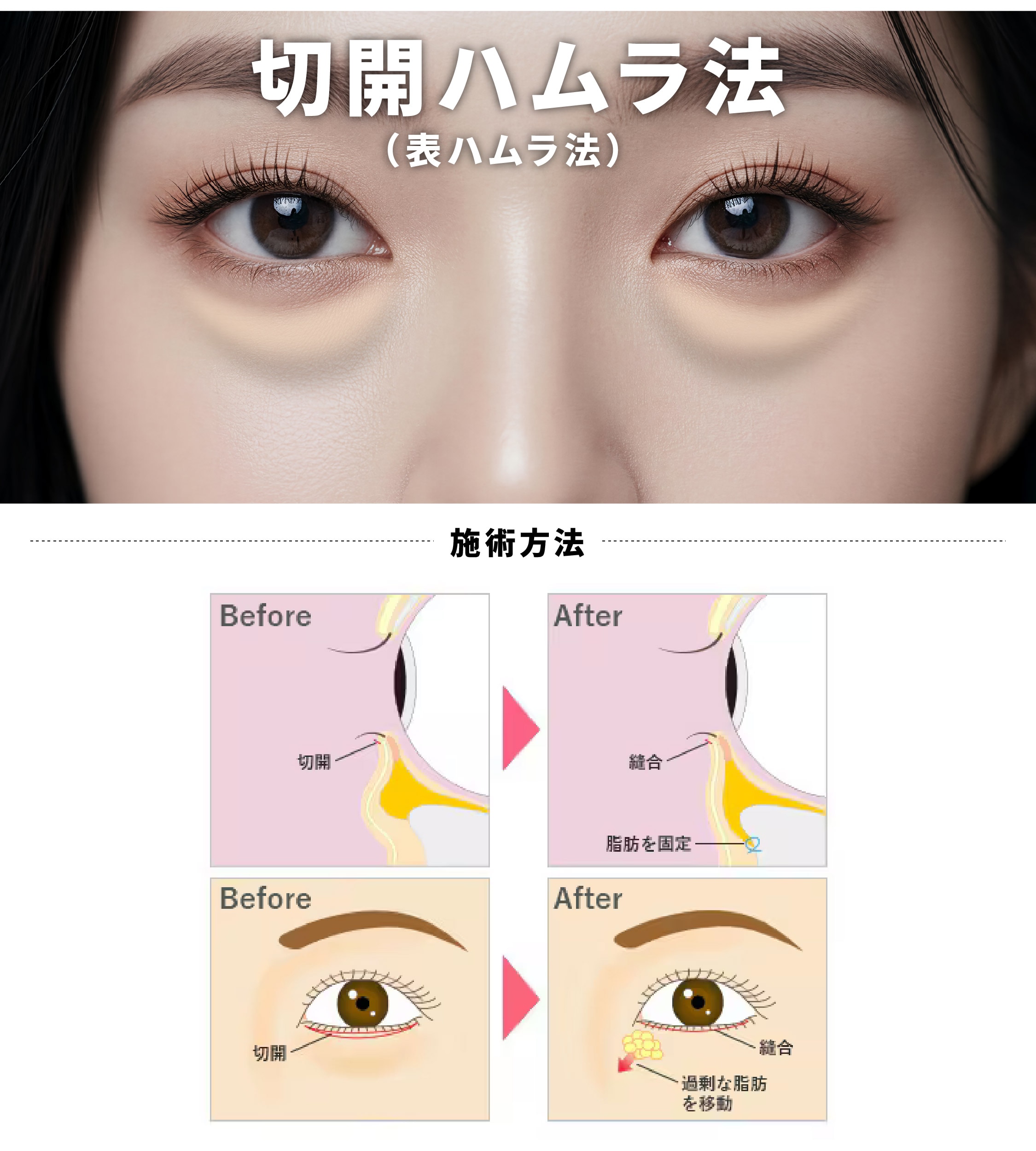 切開ハムラ法（表ハムラ法）