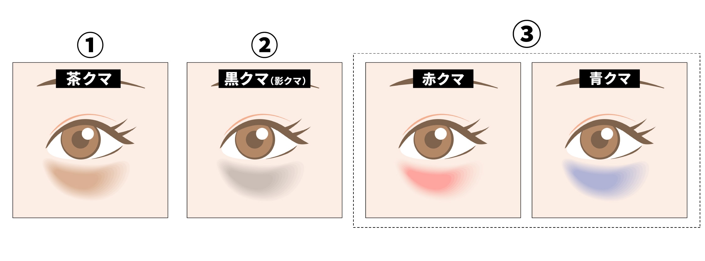 目の下のクマには大きく分けて4タイプに分かれます！