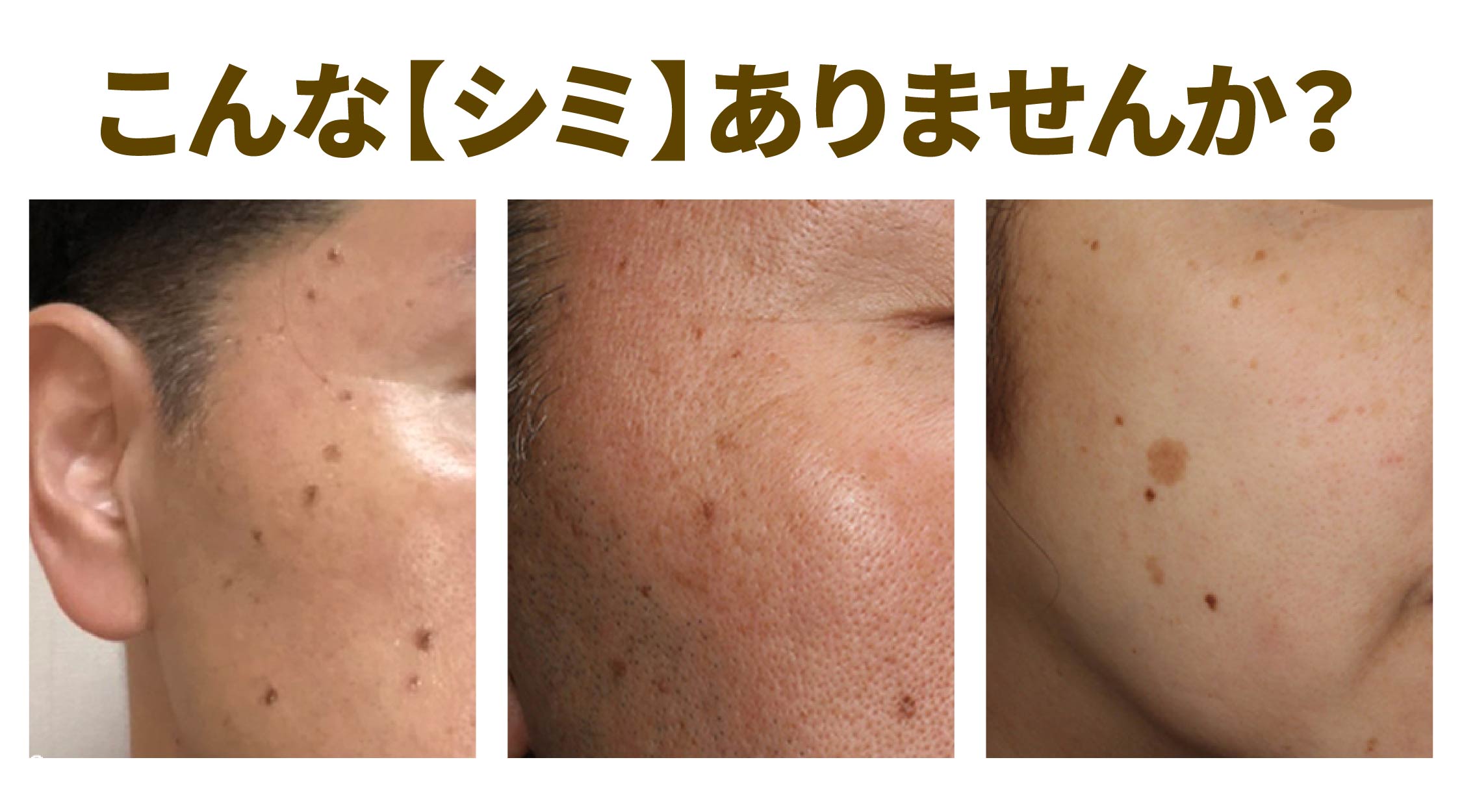 【こんなシミありませんか?】お顔にシミがあると…