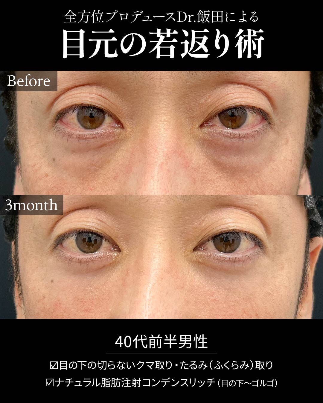 目元の若返り術