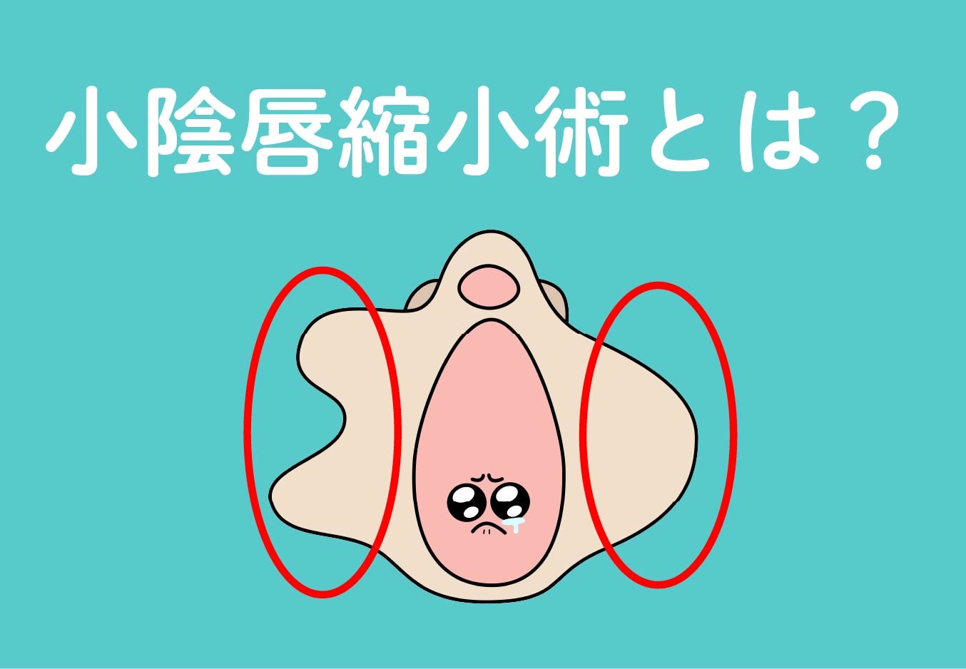 小陰唇縮小術