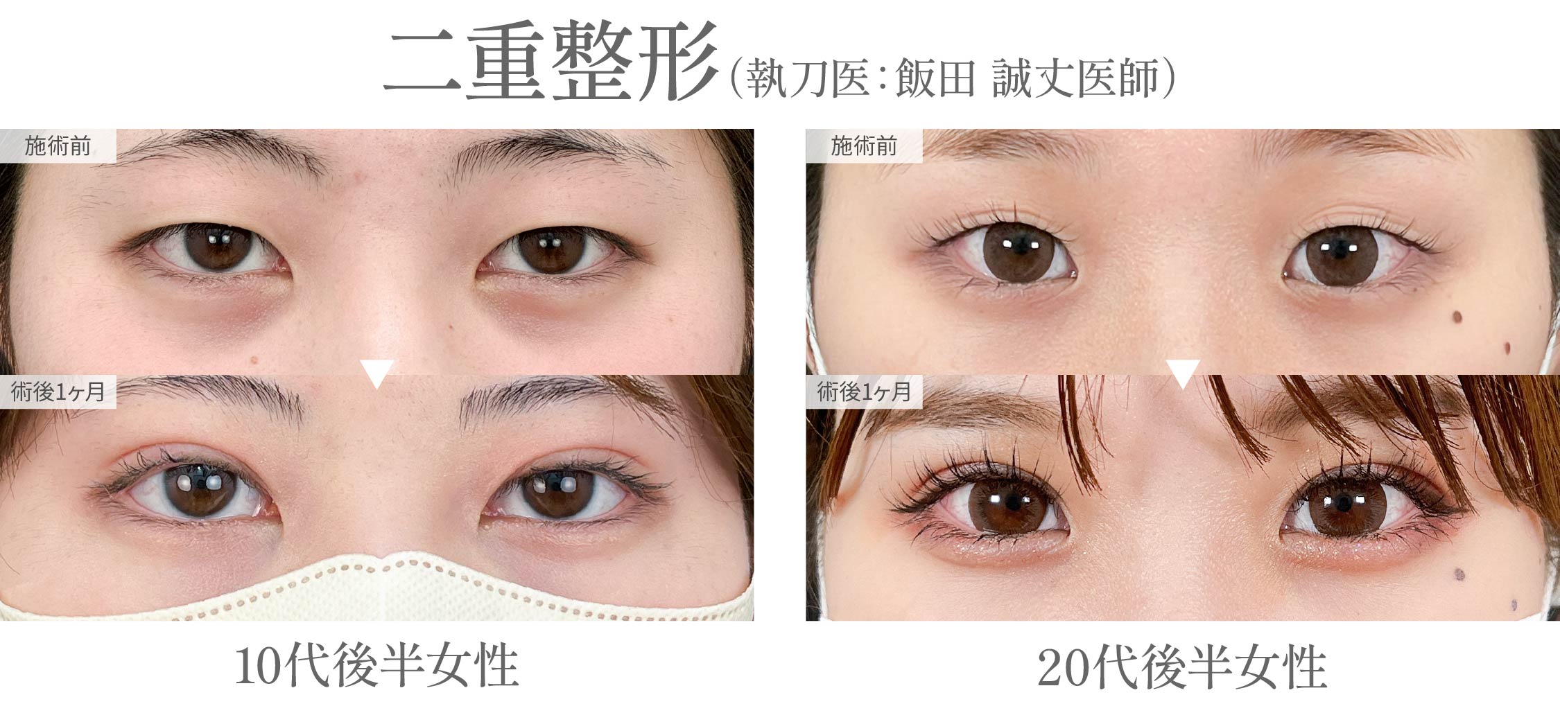 Dr.飯田による二重整形で、丸い二重ライン&ぱっちり綺麗な二重を手に入れませんか?