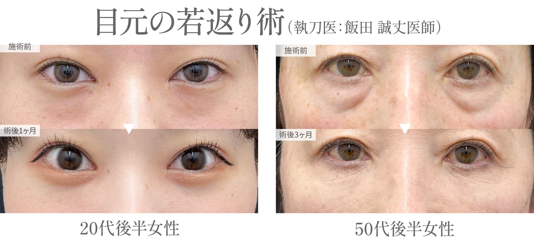 Dr.飯田によるクマ取り術で、目の下のクマを解消してスッキリ若々しいお目元を手に入れませんか?