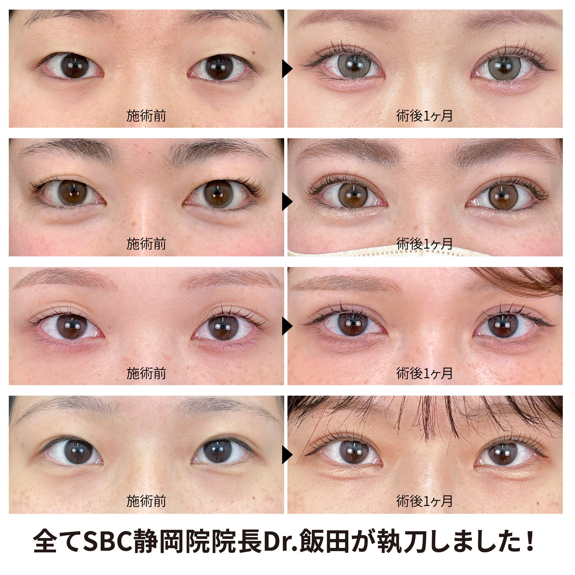 【全国から指名予約が殺到】二重整形のプロ／SBC静岡院院長 Dr.飯田の埋没法症例をチェック