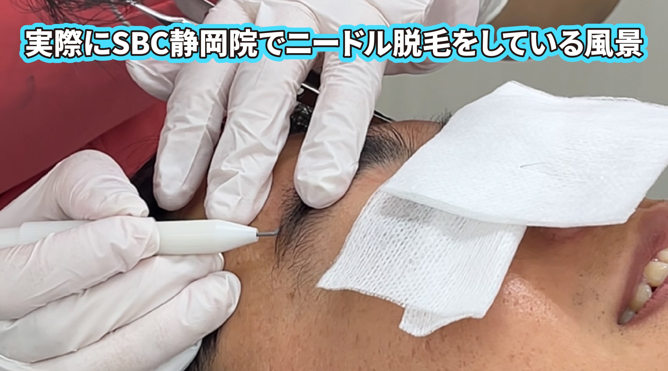 湘南美容クリニック静岡院のニードル脱毛とは？