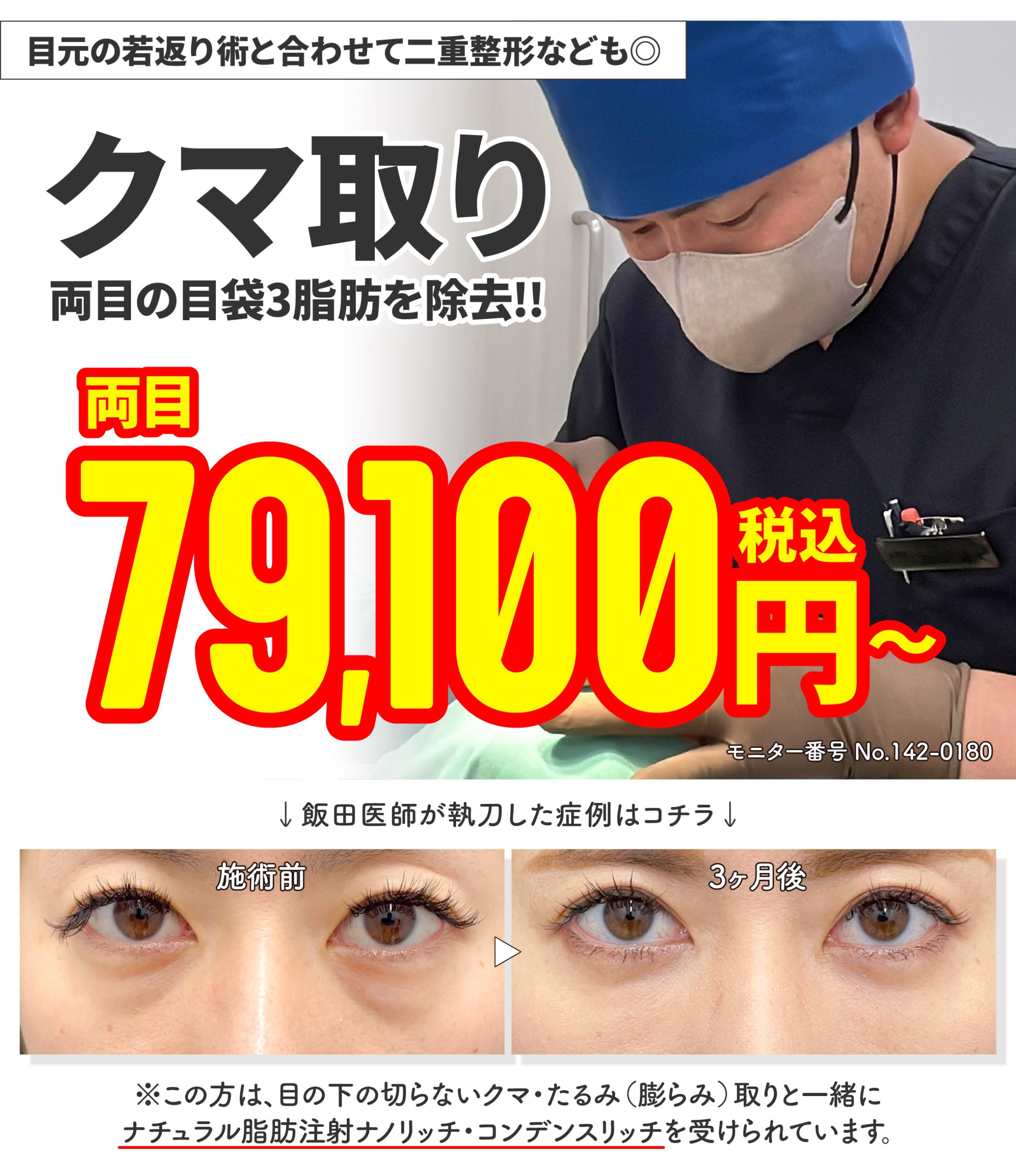【Dr.飯田執刀！モニター募集】①目の下の切らないクマ・たるみ（ふくらみ）取り