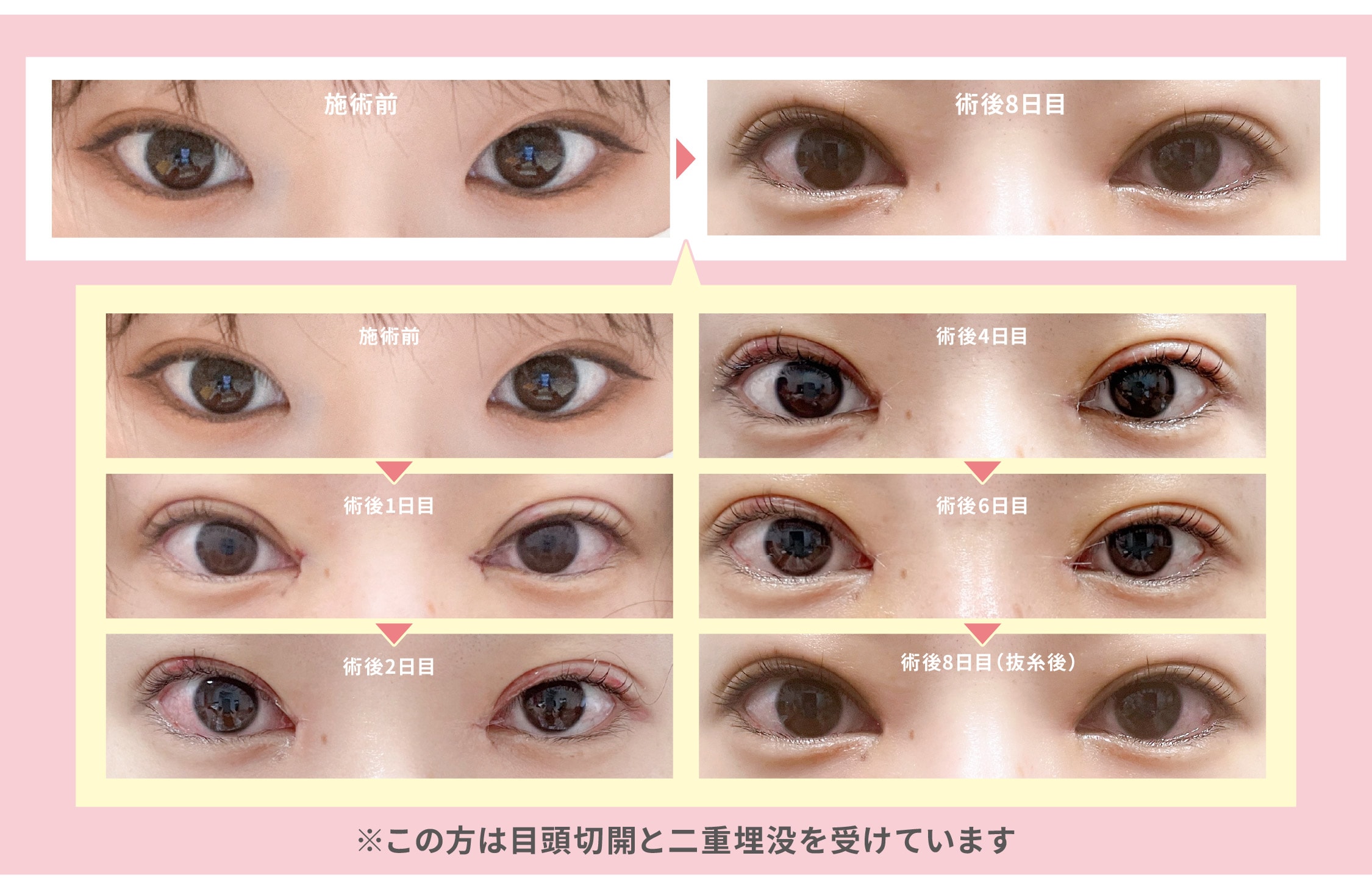 二重埋没と一緒に目頭切開を検討中なのですが、ダウンタイムはどれくらいですか？