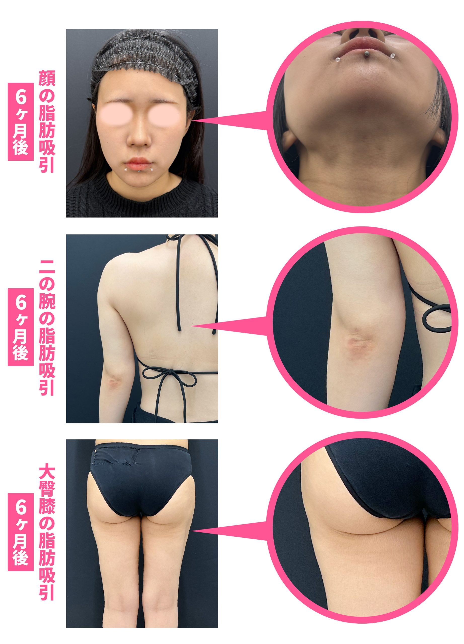 吸引口の傷口目立たない