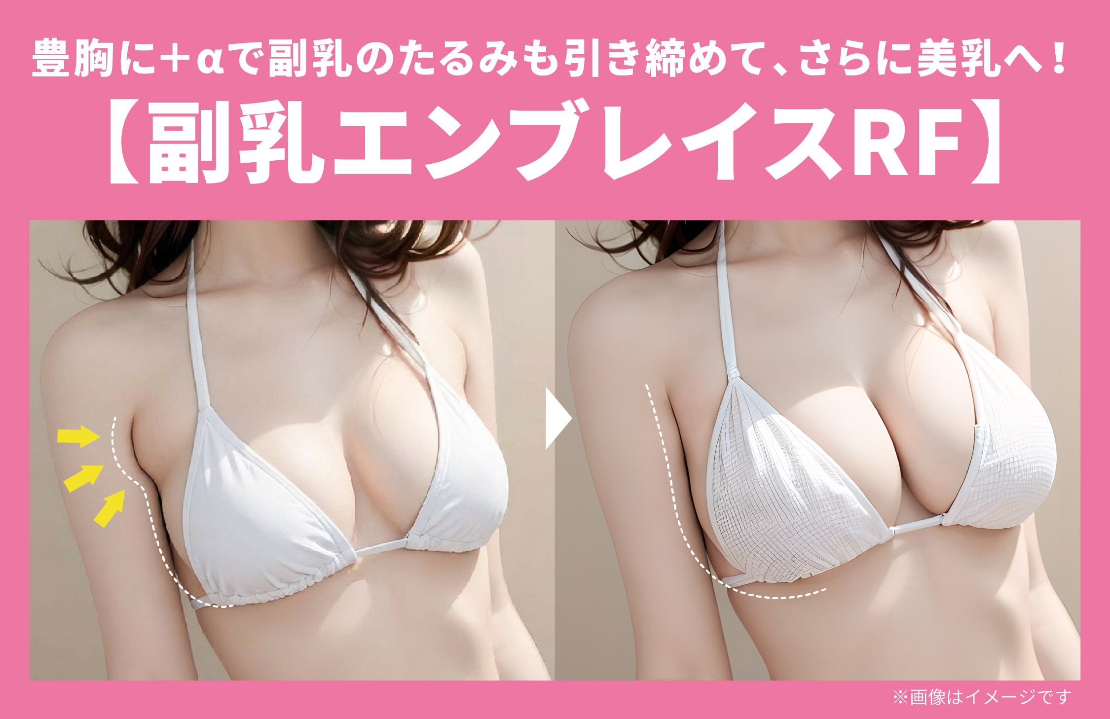 豊胸術に＋αの新常識✨【エンブレイスRF】で副乳のたるみを解消🔥