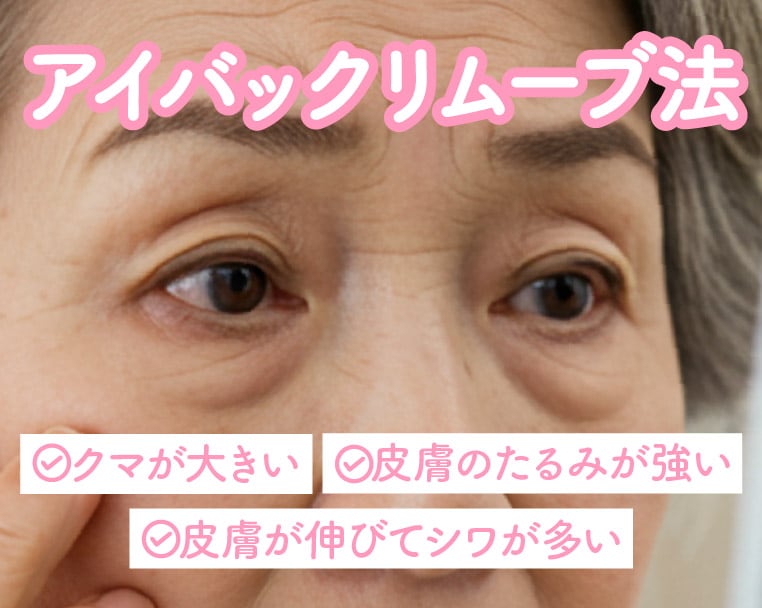静岡でたるみが強いクマ取りするなら湘南美容クリニック静岡院へ！アイバックリムーブ法で若々しい目元へ
