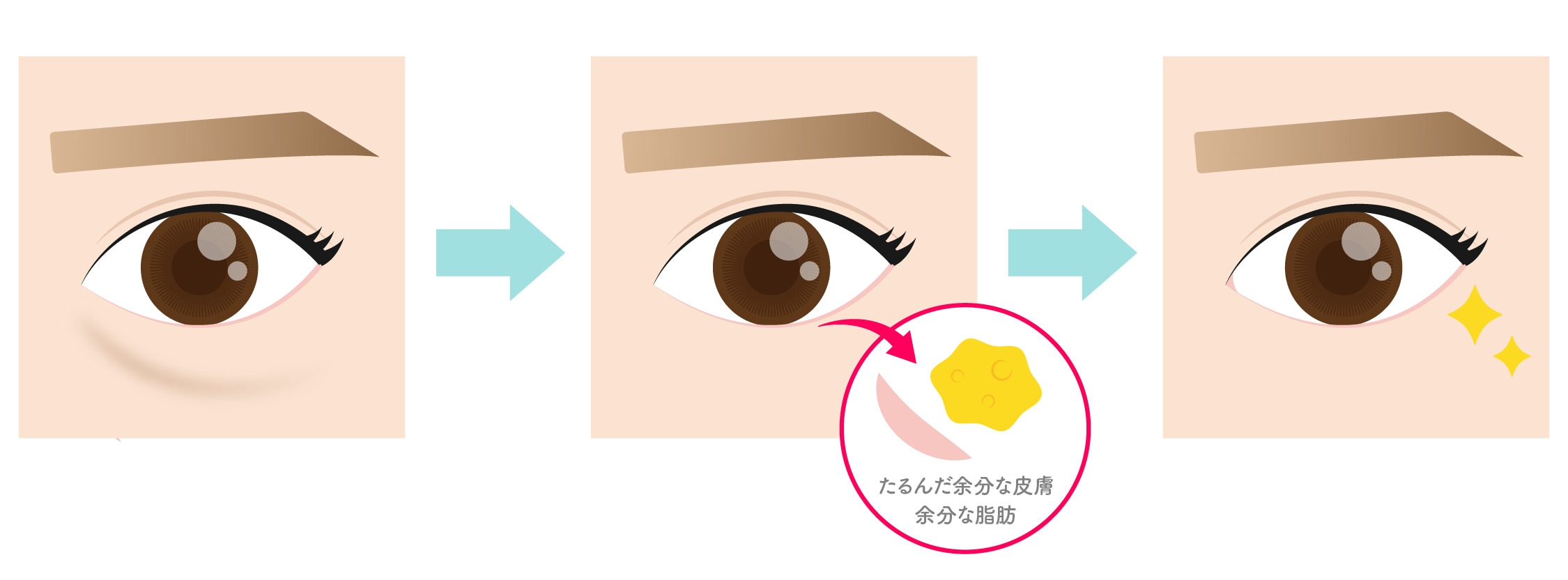 【目の下のクマ治療】アイバックリムーブ法