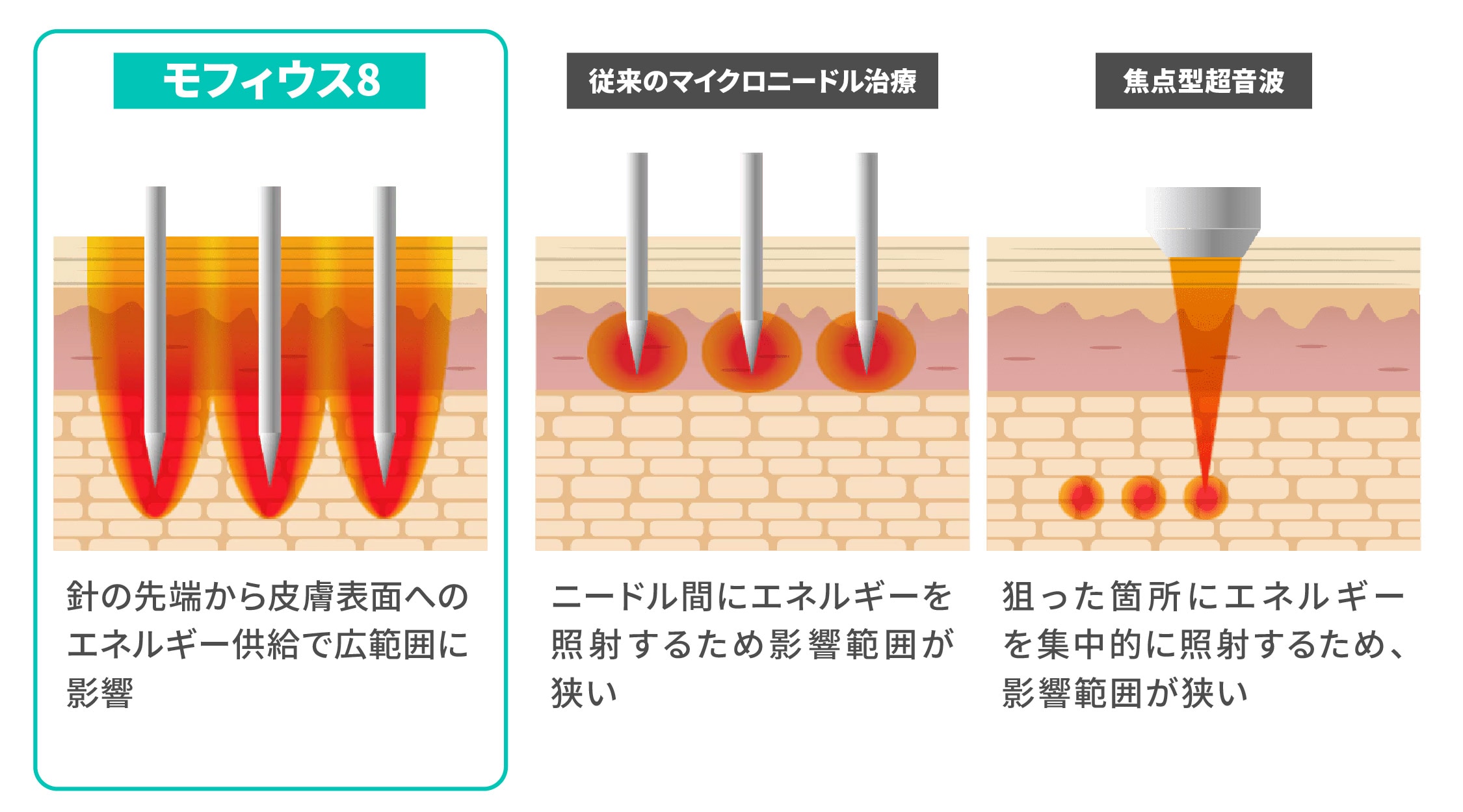 ポテンツァやシルファームX、医療ハイフなどの「たるみ治療機」との違い