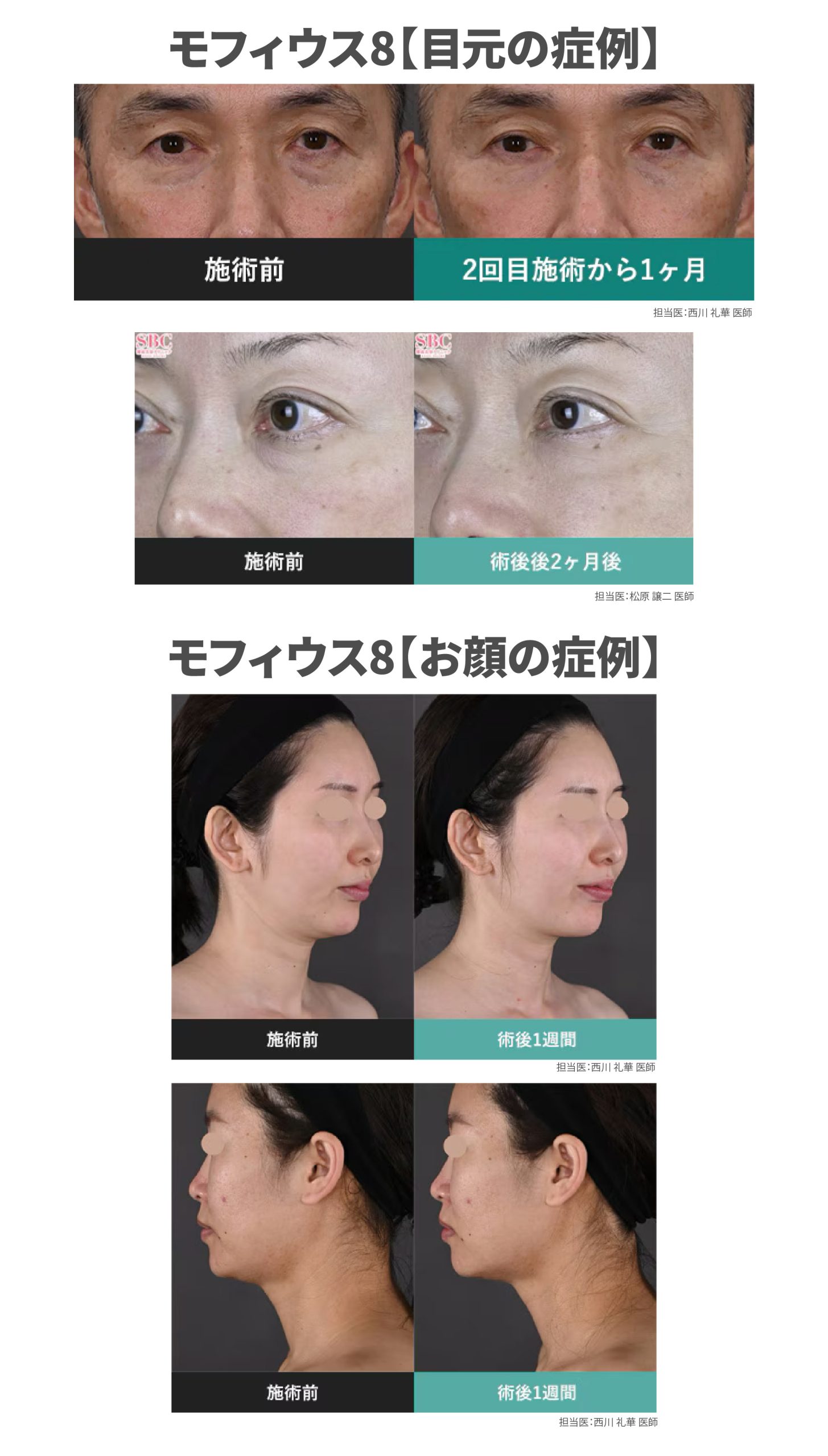 【モフィウス8】実際の症例