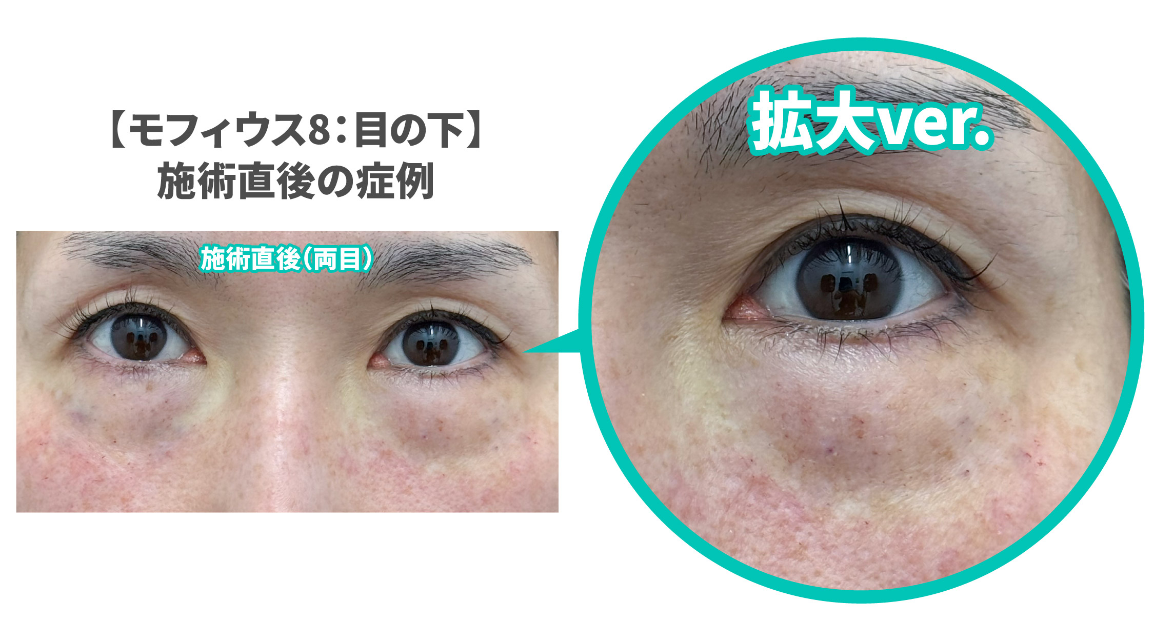 モフィウス8を受けた施術直後はどんな感じ？