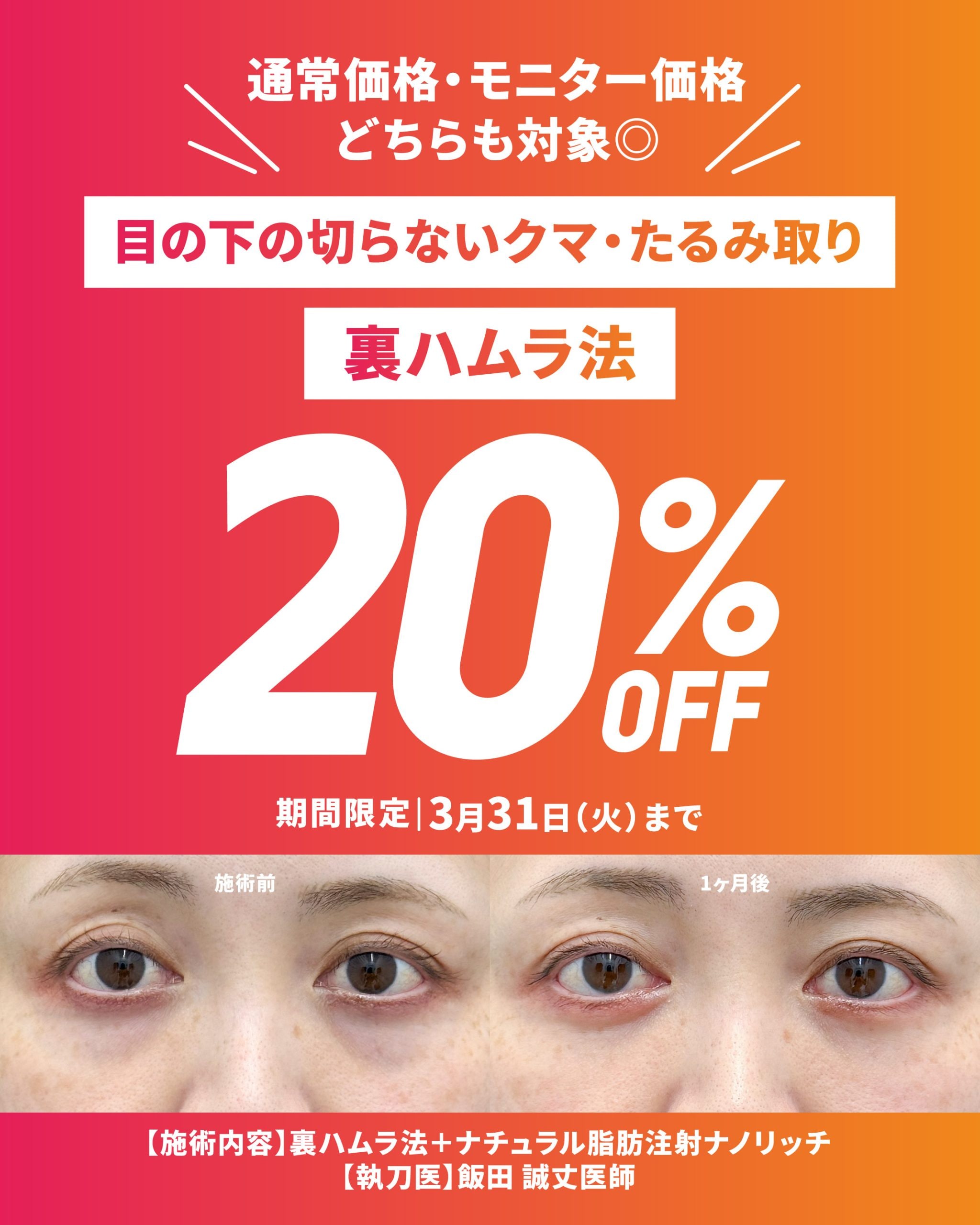 【3月31日まで】クマ取り＆裏ハムラ法が今なら20%OFF🔥