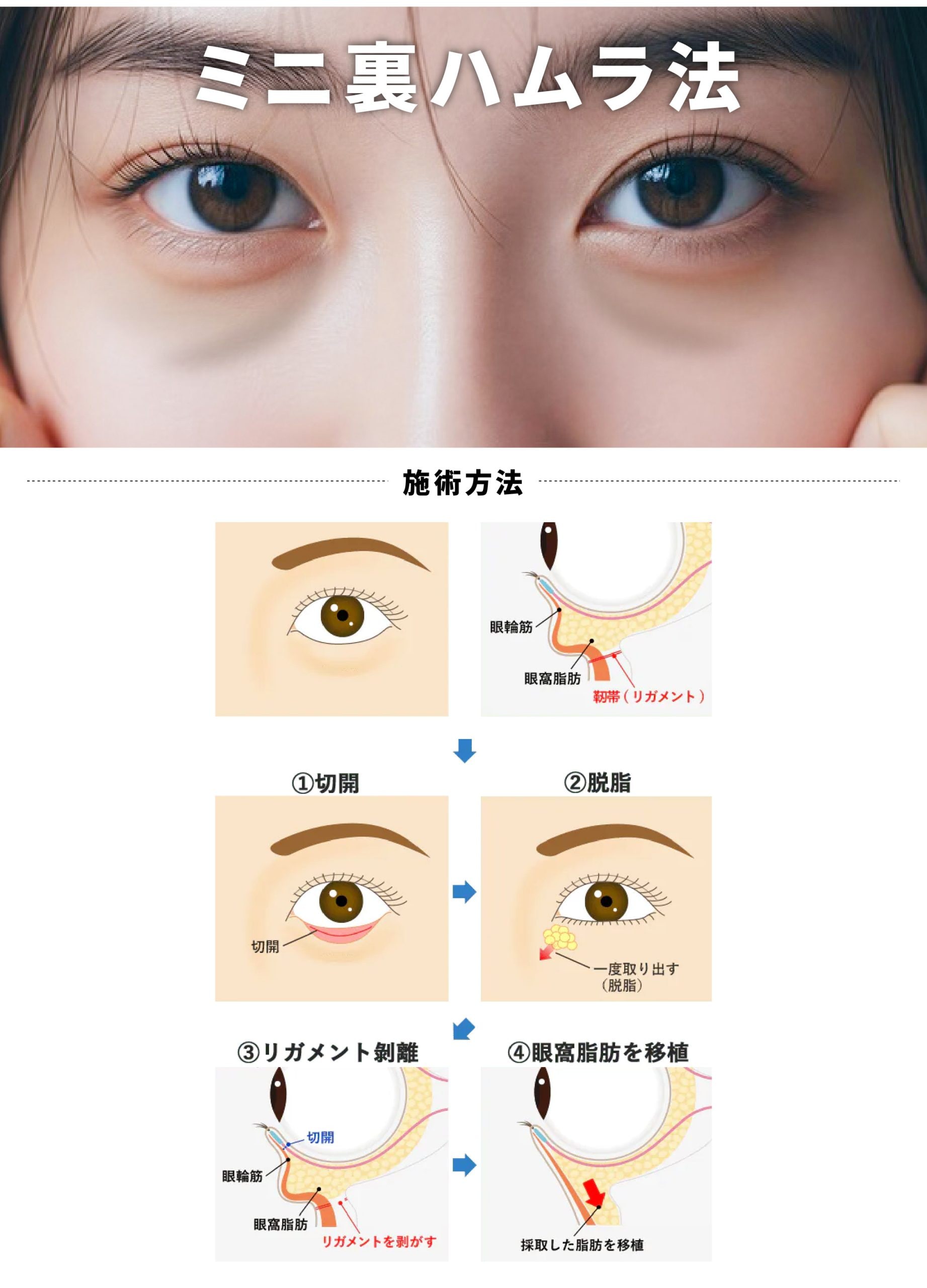 ミニ裏ハムラ法