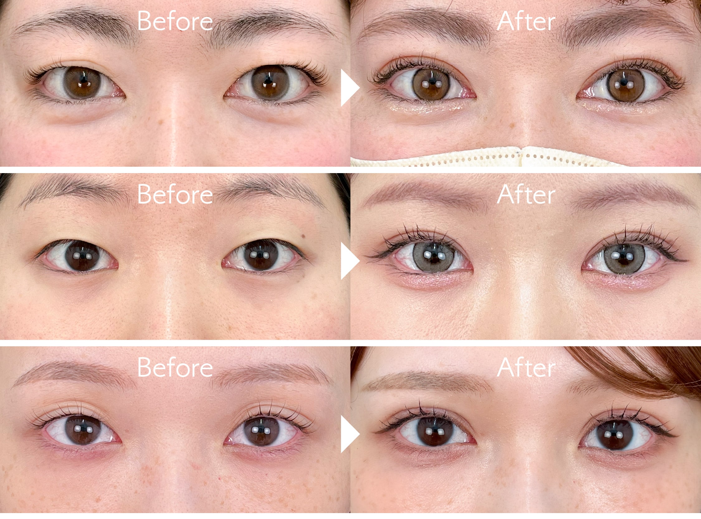 二重埋没の名医であるDr.飯田執刀の二重症例