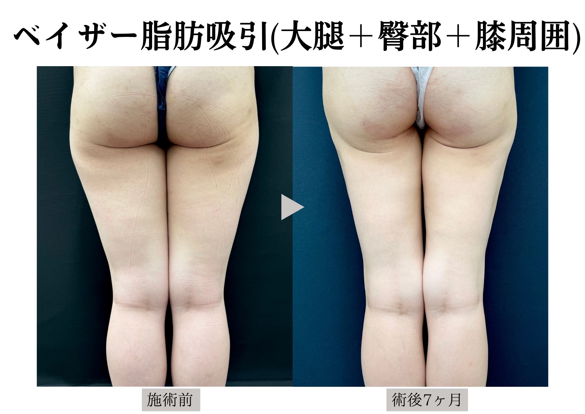 人気部位2位✨【太もも＋お尻＋膝周囲】