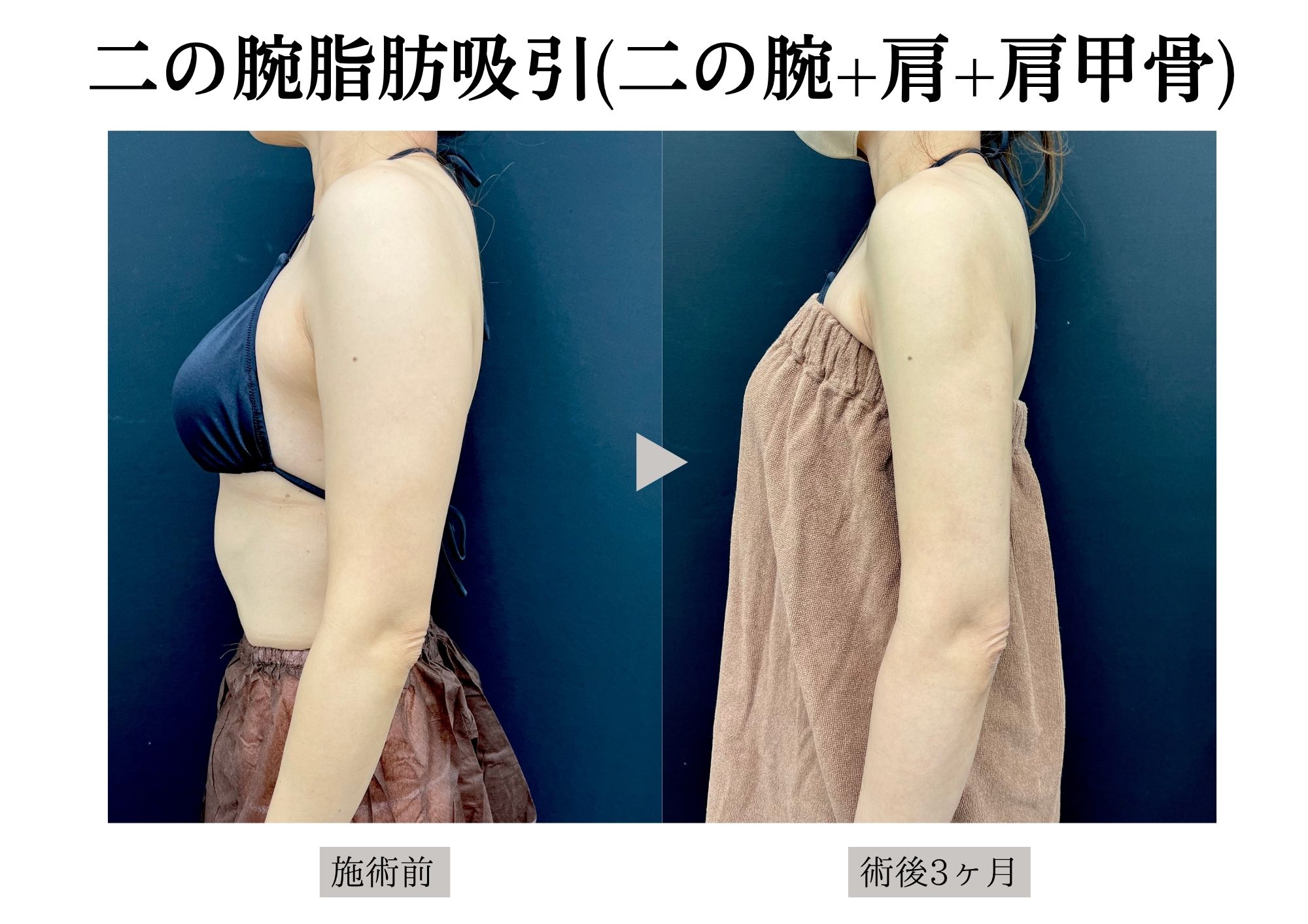 人気部位3位✨【二の腕】