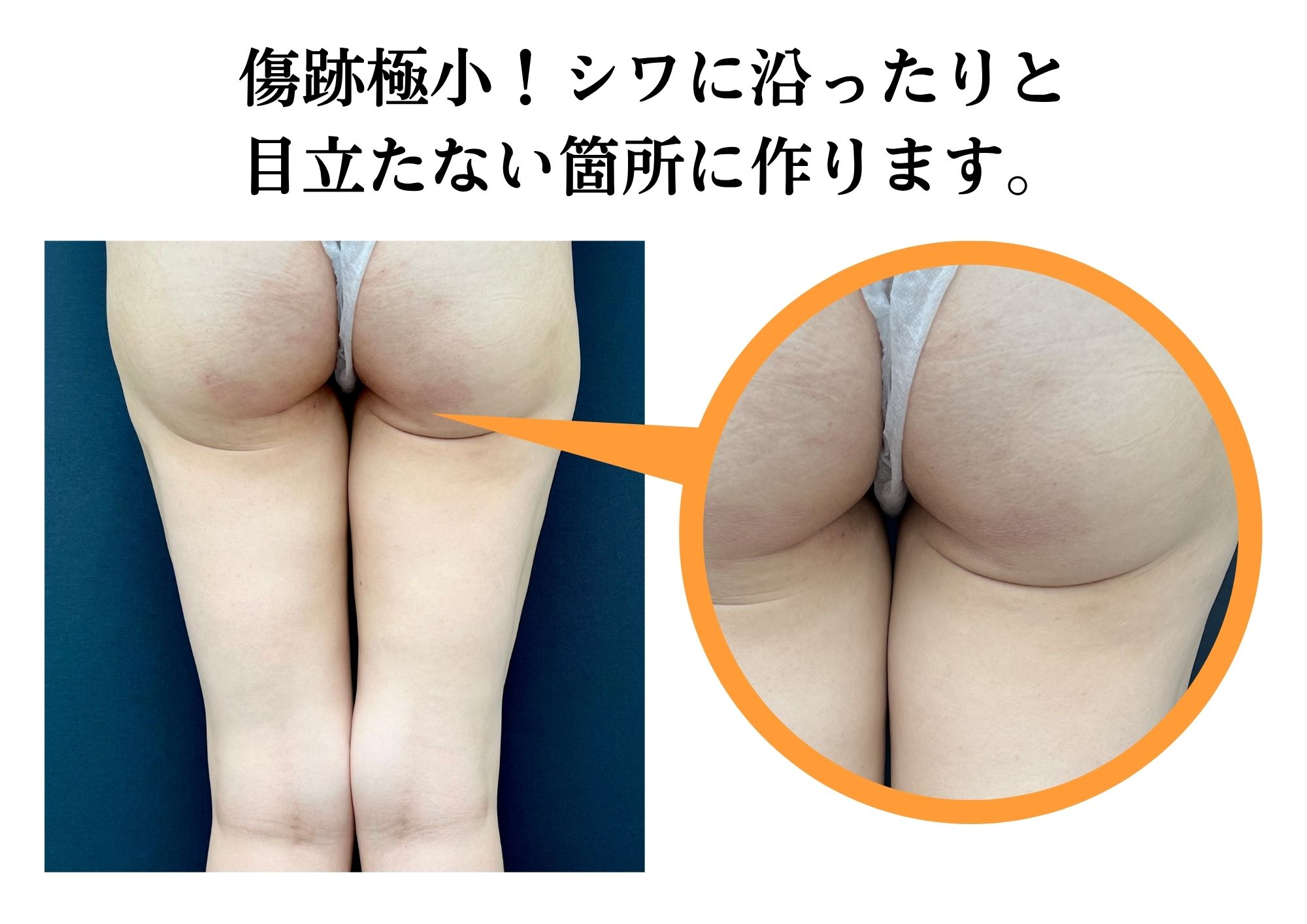 吸引口の傷口目立たない