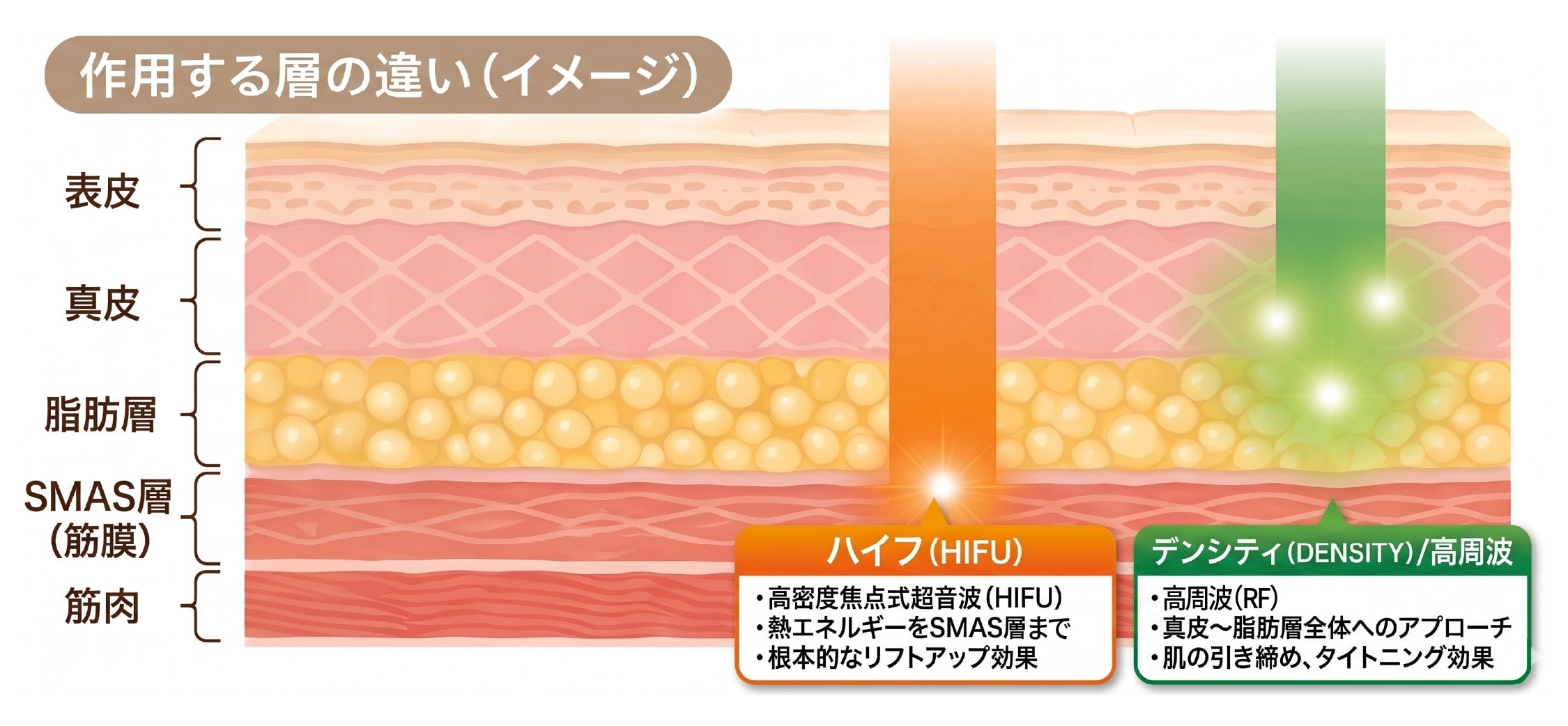 ウルトラリフトプラスHIFU（ハイフ）とデンシティは<br />
組み合わせると、さらに効果的！
