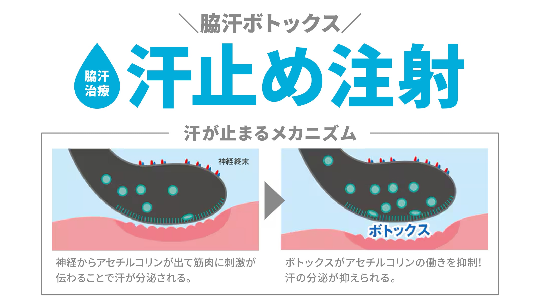 汗止め注射（脇汗ボトックス注射）