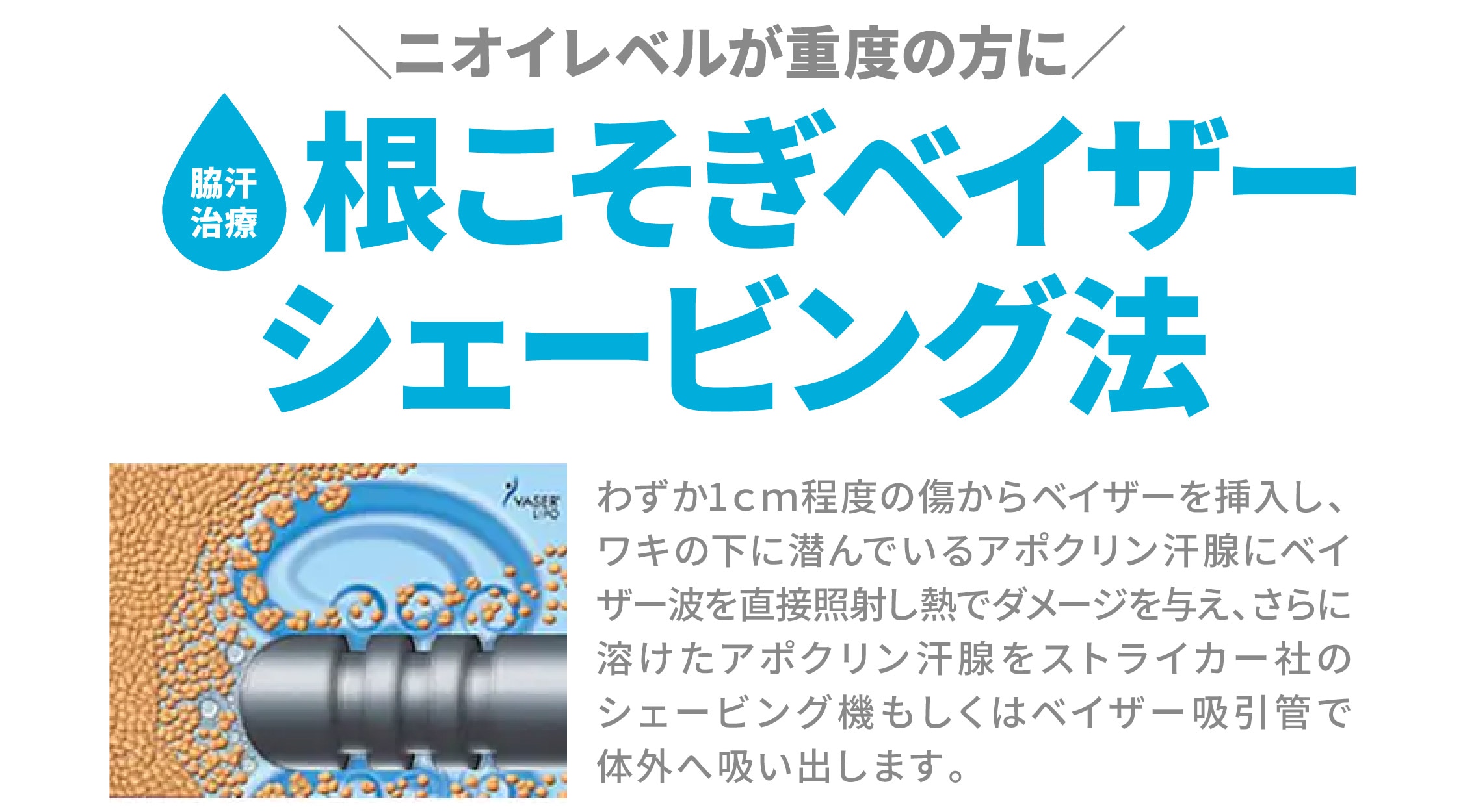 根こそぎベイザーシェービング法