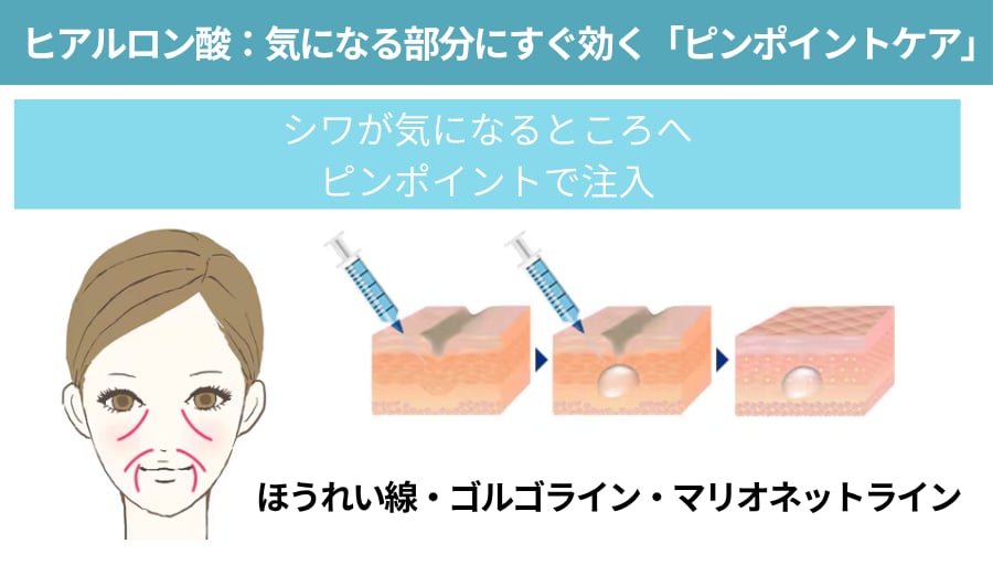 ヒアルロン酸注入｜気になる部分にすぐ効く「ピンポイントケア」