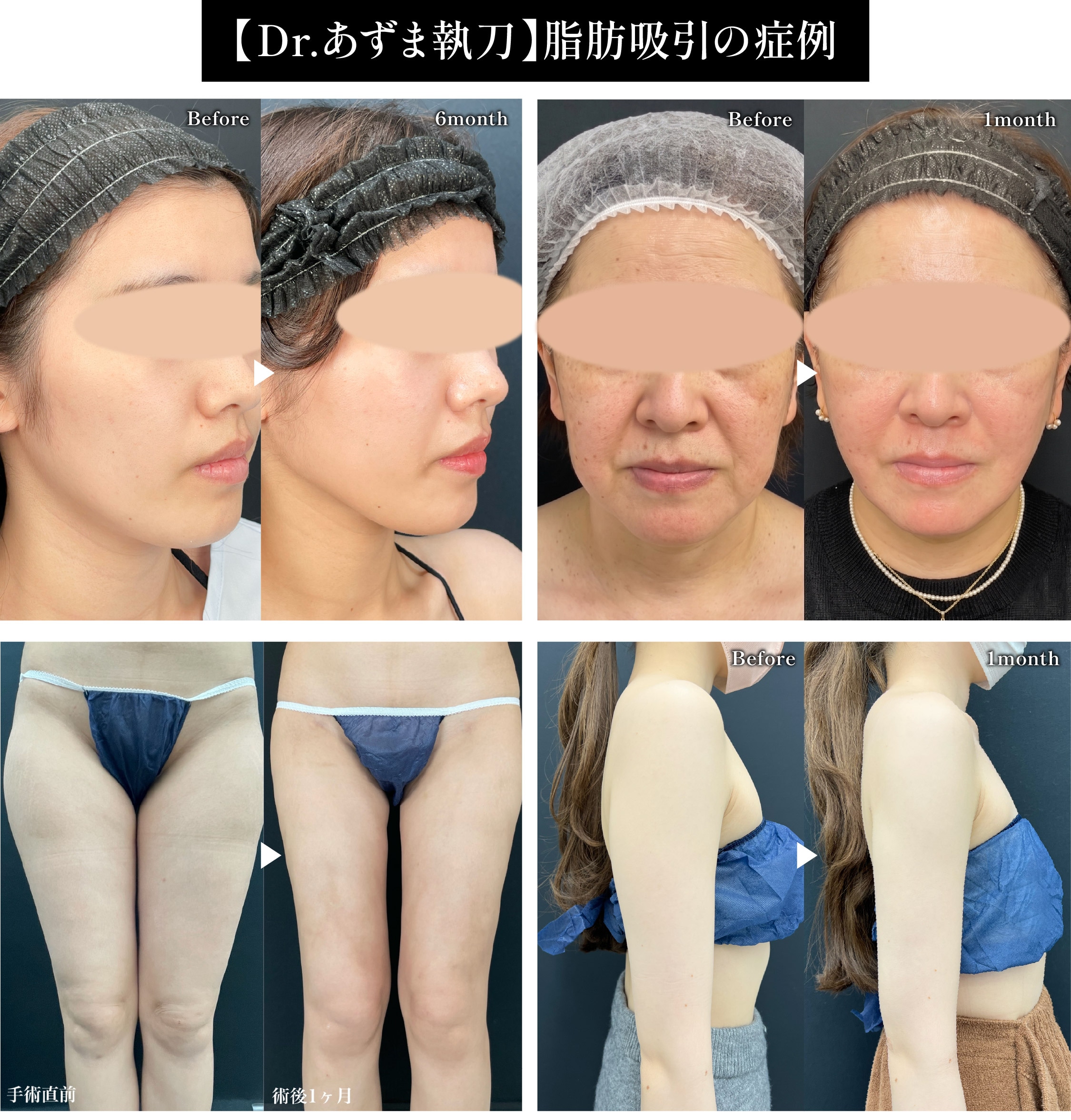 【9月限定】脂肪吸引モニター募集✨