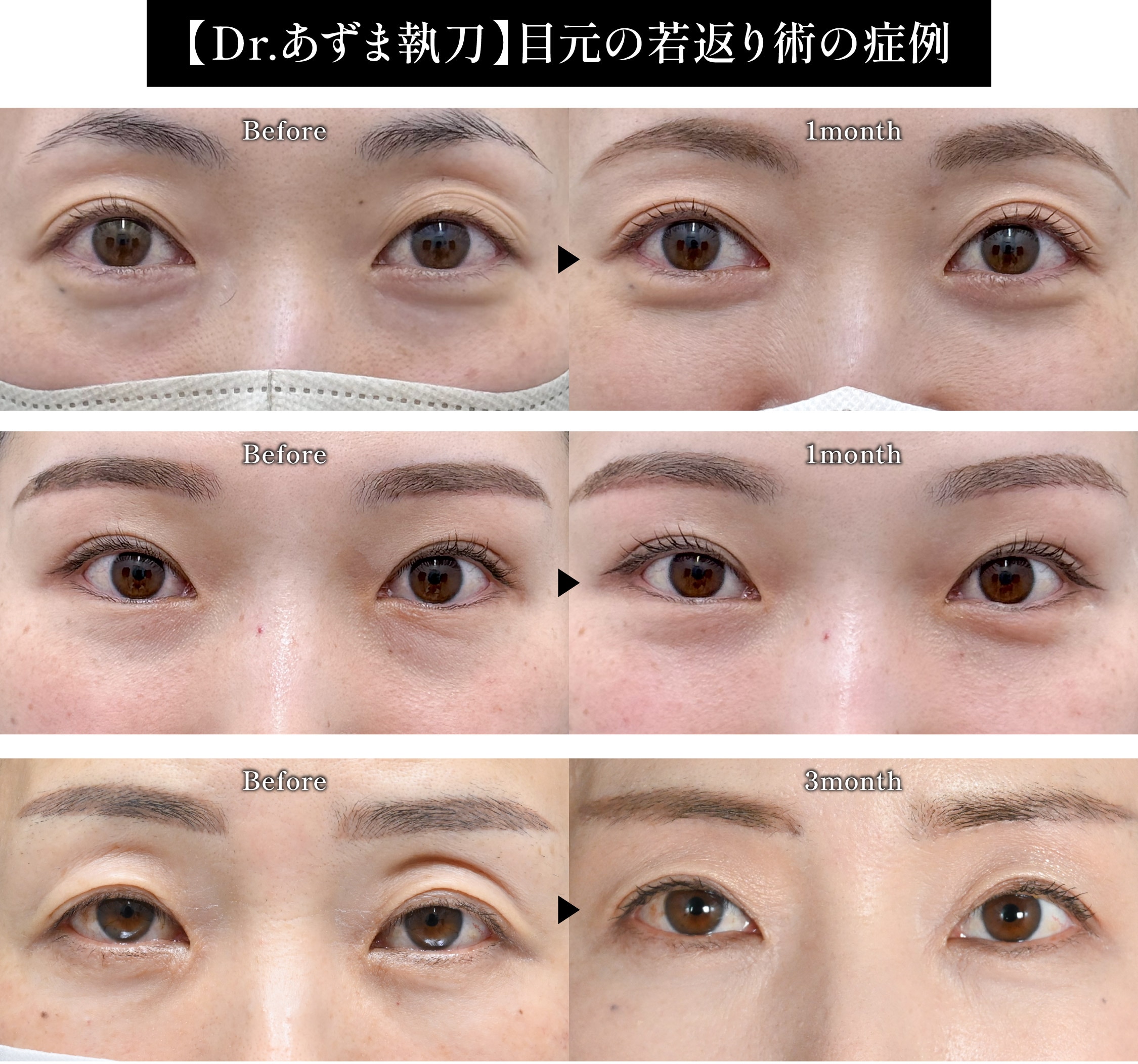 【9月限定】目元の若返り術モニター募集✨