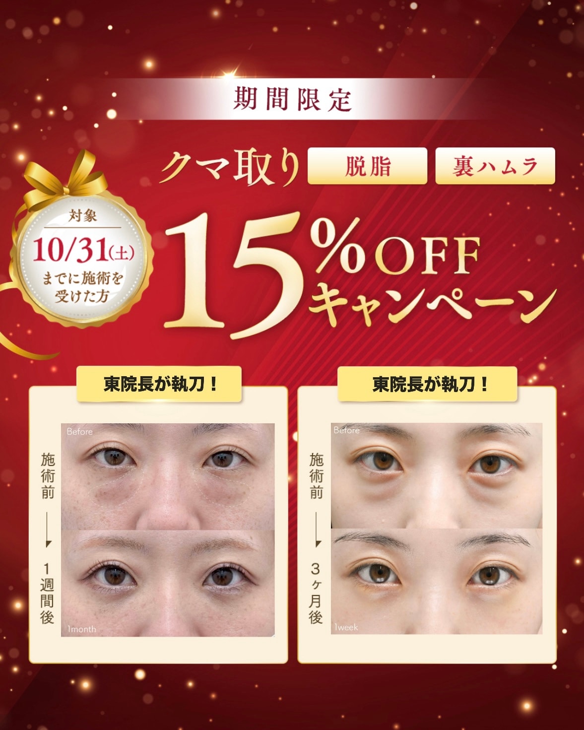 目の下の切らないクマ・たるみ（ふくらみ）取り<br />
裏ハムラ法15%OFFキャンペーン実施中🔥🉐<br />
